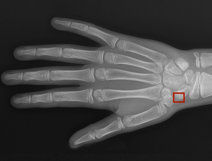 Imagen: La solución Rayvolve ha recibido la autorización 510(k) de la FDA de EUA para la detección de fracturas pediátricas (foto cortesía de Azmed)